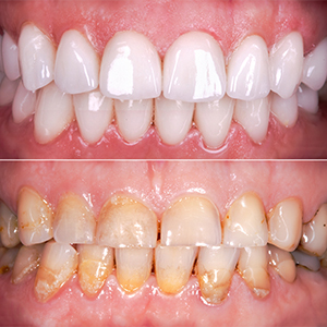 Scaling Prophylaxix Cleaning