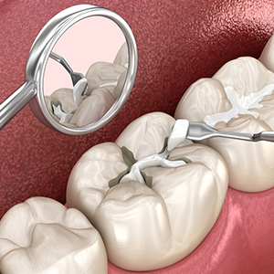 Dental Fillings & Restoration