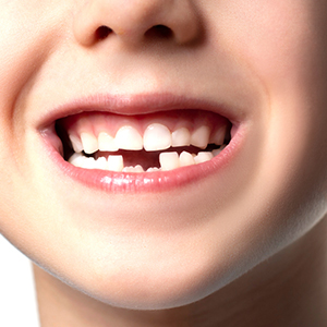 Mobility of Teeth / Looser Teeth