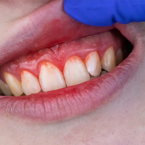 Periodontal Gum Therapy