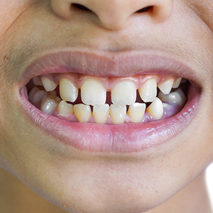 Gaps / Spacing between Teeth